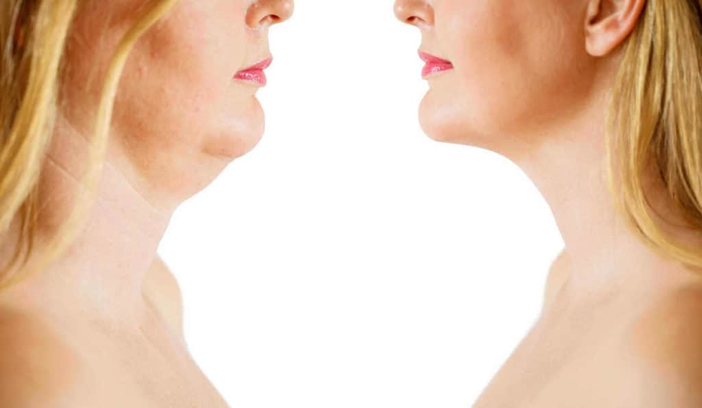 Double Chin treatment West Ealing before and after results