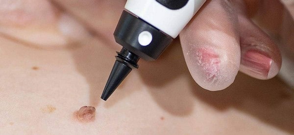 After Skin Tag Removal West Ealing