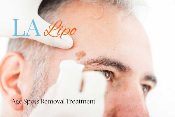 What Are the Most Effective Treatments for Age Spots West Ealing?