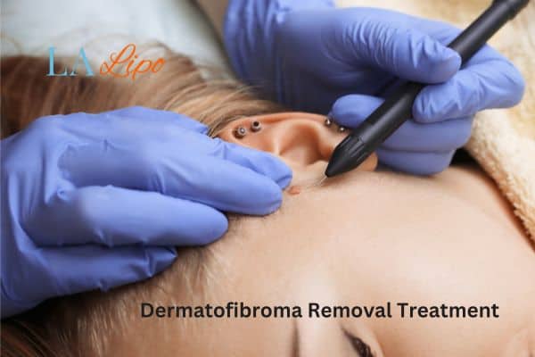 Dermatofibroma Removal Treatment West Ealing