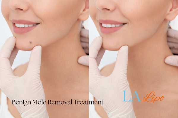 woman's before and after mole removal West Ealing results