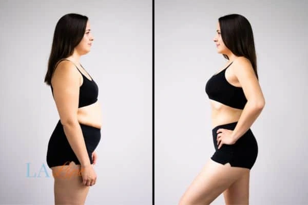 image of woman before and after results of LA-EMS Body Sculpting West Ealing to help treat Diastasis recti