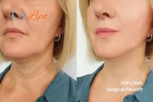 hi-fu for wrinkles West Ealing before and after results