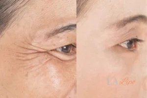 Before and after results of woman - HI-fu wrinkles reduction treatment West Ealing