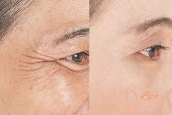 Before and after results of woman - HI-fu wrinkles reduction treatment West Ealing