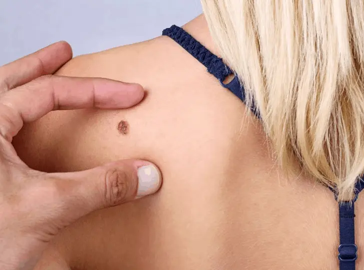 woman having mole removal West Ealing consultation before treatment.