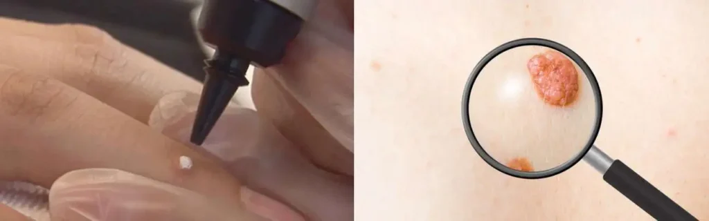 Cryopen for mole removal West Ealing - speak to our team today!