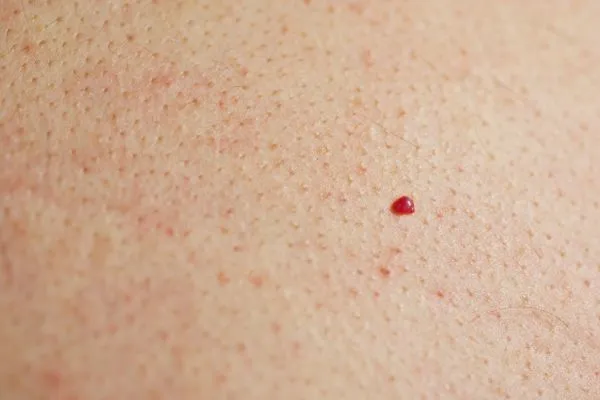 close up of a cherry angioma West Ealing