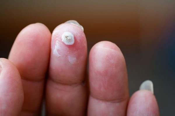 wart on person finger - cryotherapy to treat from LA LIPO West Ealing