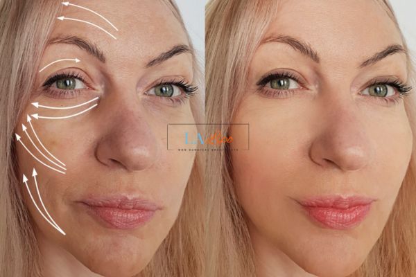 Morpheus 8 results West Ealing face lift.