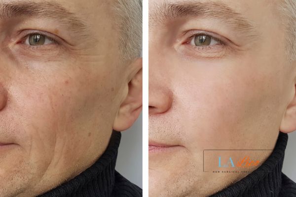 See the amazing results of Morpheus8 Treatment West Ealing!