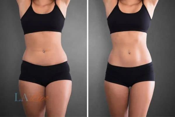 before and after results of non-surgical treatment to help a woman's body image and mental health West Ealing