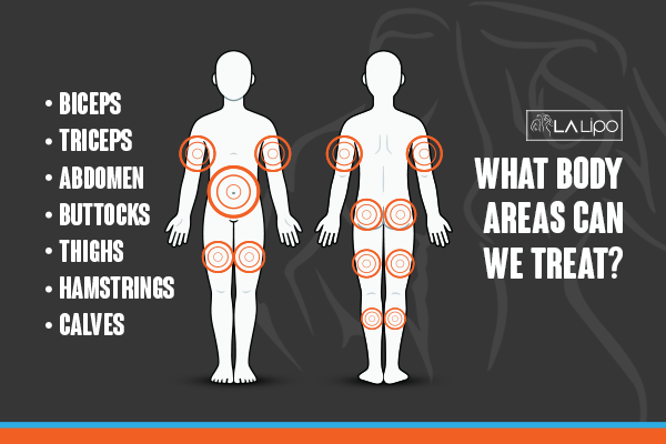 Diagram to show areas you can have LA-EMS Body Sculpting Treatment West Ealing