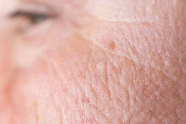 close up picture of a woman's face showing an age spot West Ealing