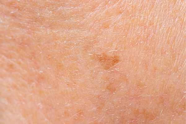 close up picture of age spots West Ealing