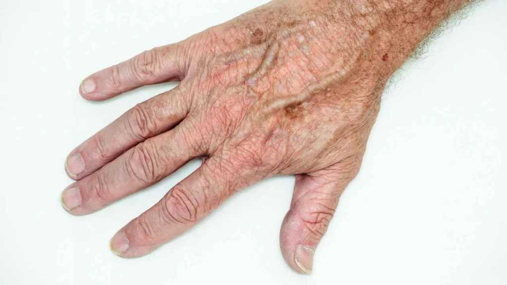 Male hand showing age spot West Ealing