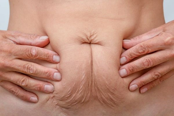 Should I Combine Diastasis Recti Treatment with Body Contouring for Better Results West Ealing?